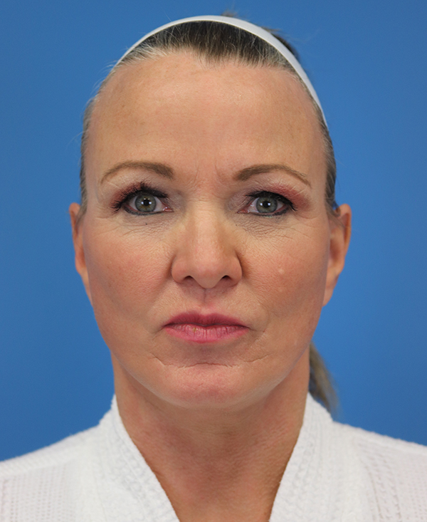 Facelift Results Austin TX