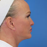 beautiful woman with less visible excess neck skin, Neck Contouring, Austin TX