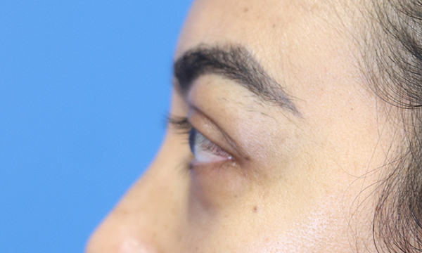 Eyelid Surgery Results Austin