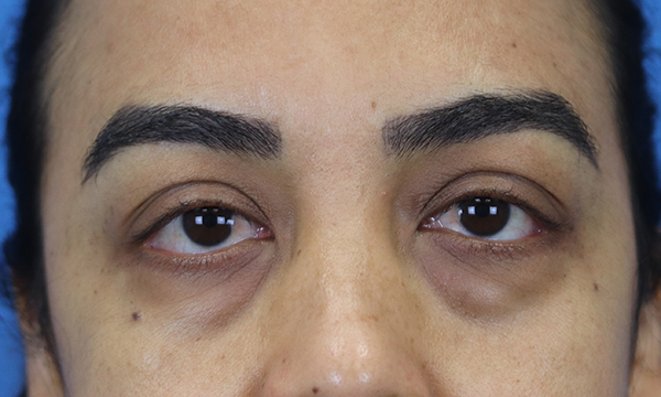 before eyelid surgery