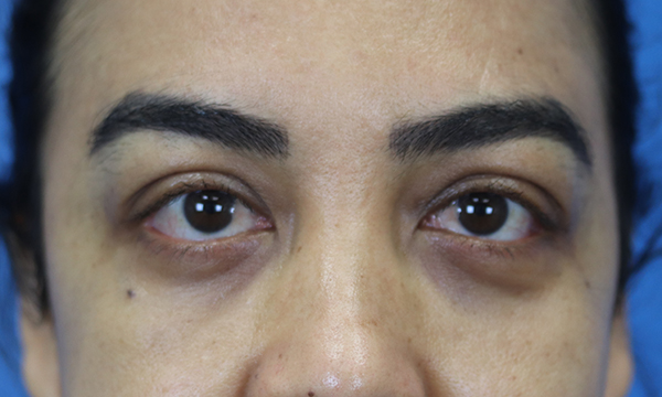 after eyelid surgery