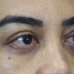 Eyelid Surgery Results Austin