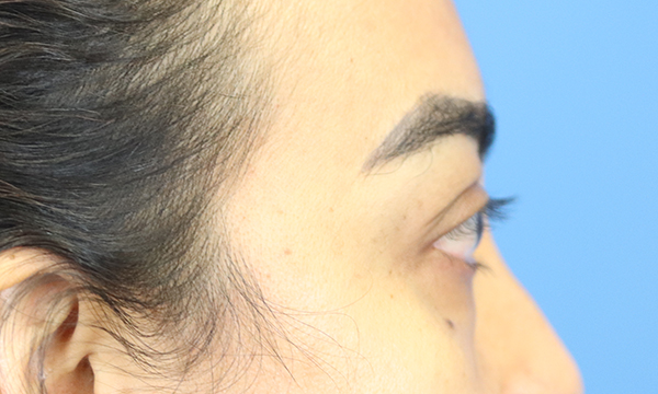 Eyelid Surgery Results Austin