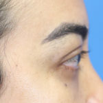 Eyelid Surgery Results Austin