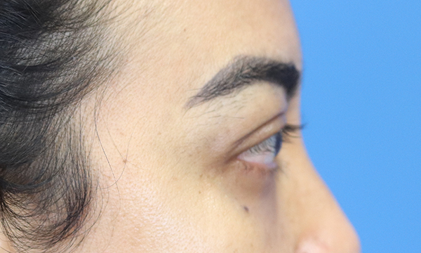 Eyelid Surgery Results Austin