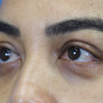 Eyelid Surgery Results Austin