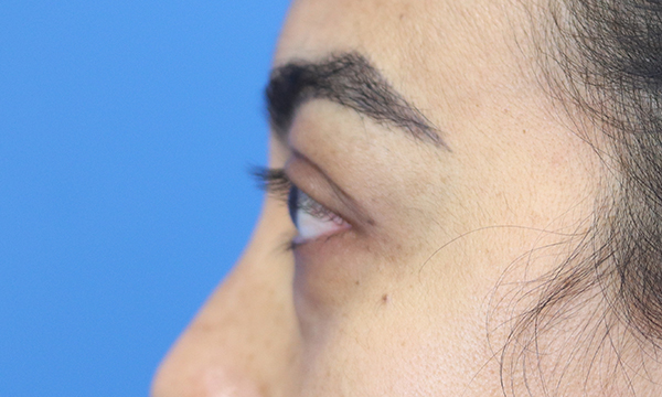 Eyelid Surgery Results Austin