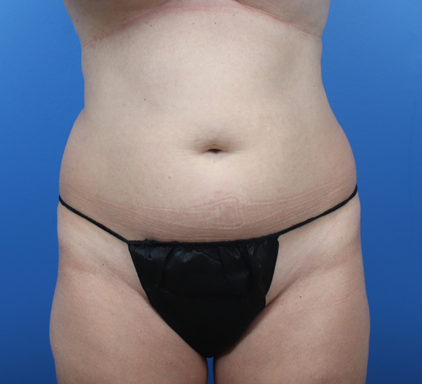 Liposuction Before