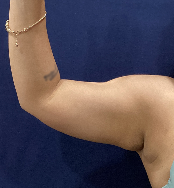 before photo of short scar brachioplasty