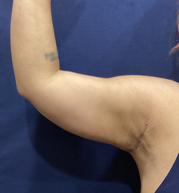 after photo of short scar brachioplasty