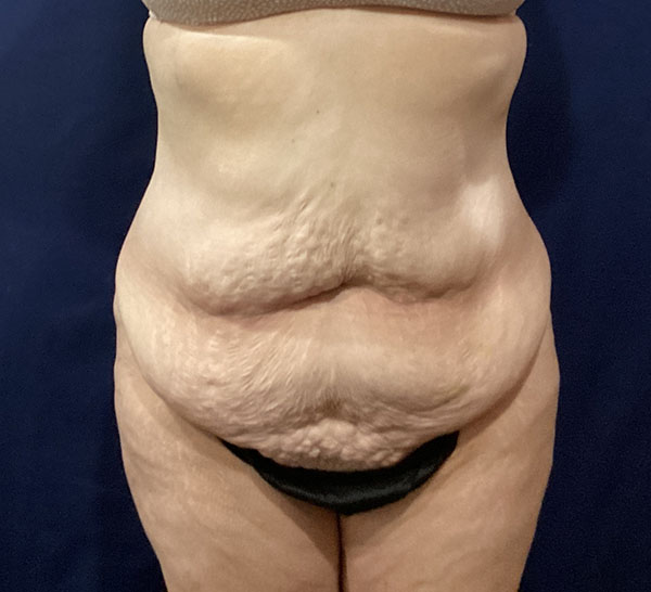 Abdominal skin texture highlighting post-pregnancy changes, relevant for patient education.