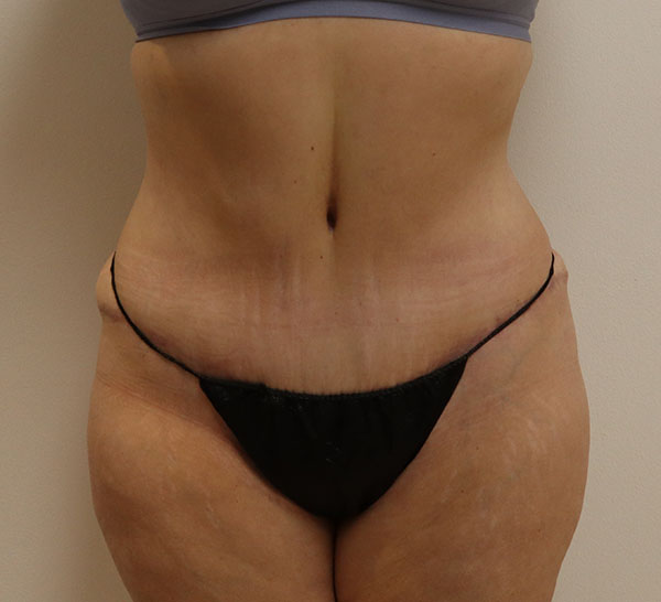 Patient's abdomen post-treatment, showcasing skin texture and contour changes.
