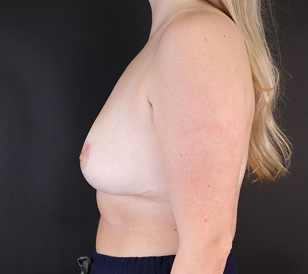 Profile view of a patient highlighting breast contour and symmetry.