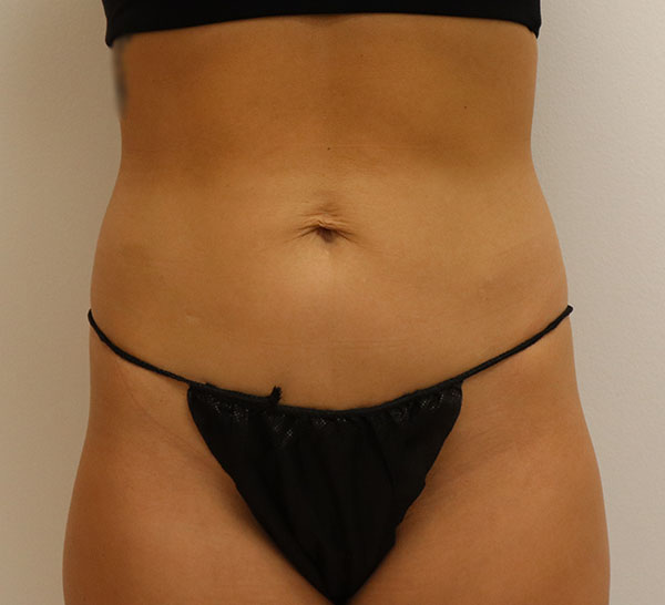 Abdomen and waist in black lingerie, highlighting body contouring potential.