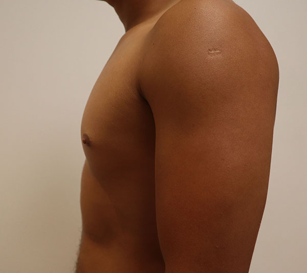 Male patient profile showcasing healthy skin and arm anatomy.