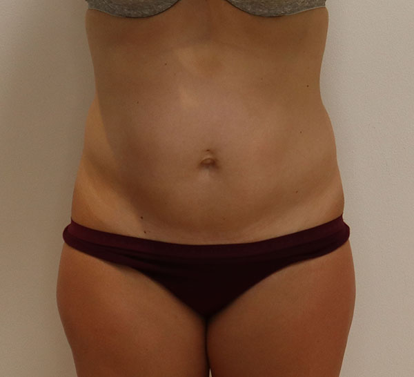 Patient's abdomen before treatment, showcasing skin texture and contour.