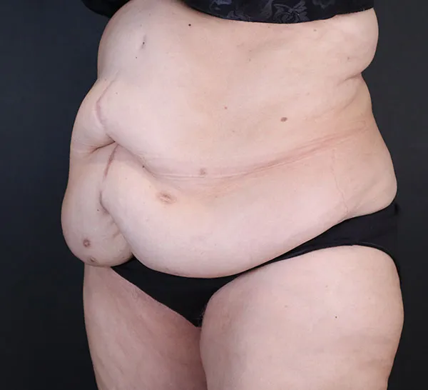 Left oblique view of abdomen before abdominoplasty by Dr. Daniela Atencio.