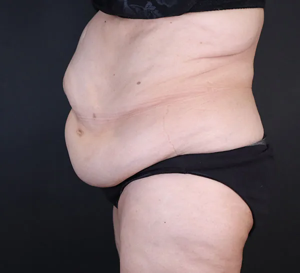 Left-side view of abdomen before abdominoplasty procedure by Dr. Daniela Atencio.