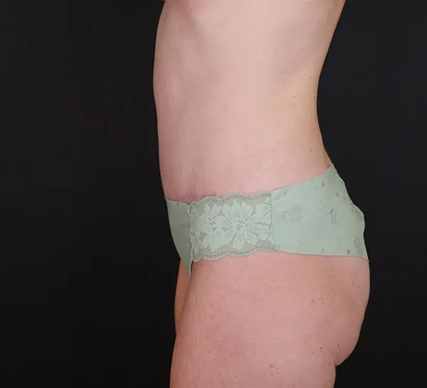 Left-side view of post-abdominoplasty results, showcasing smooth contours.