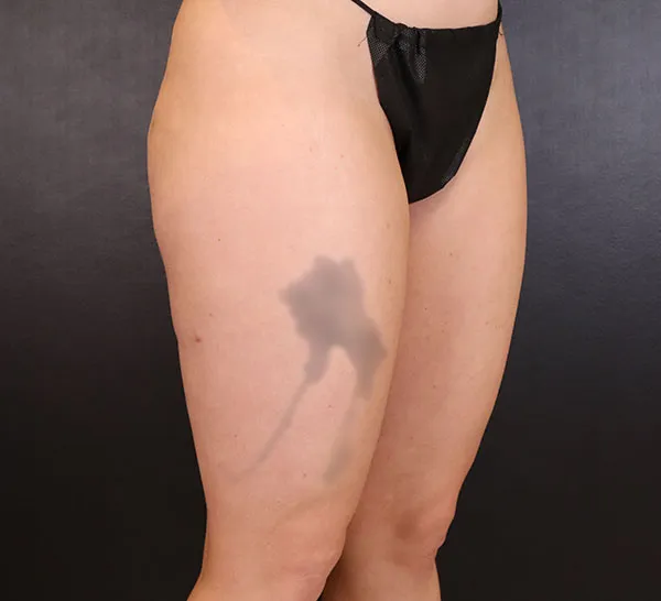 After outer thigh liposuction, showcasing smooth contours and professional results.